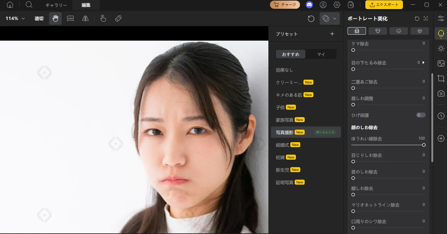 ほうれい線除去後